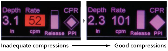 Inadequate versus good compressions on the X Series and R Series
